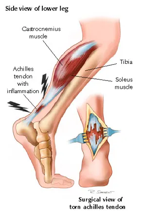 Achilles anatomy diagram